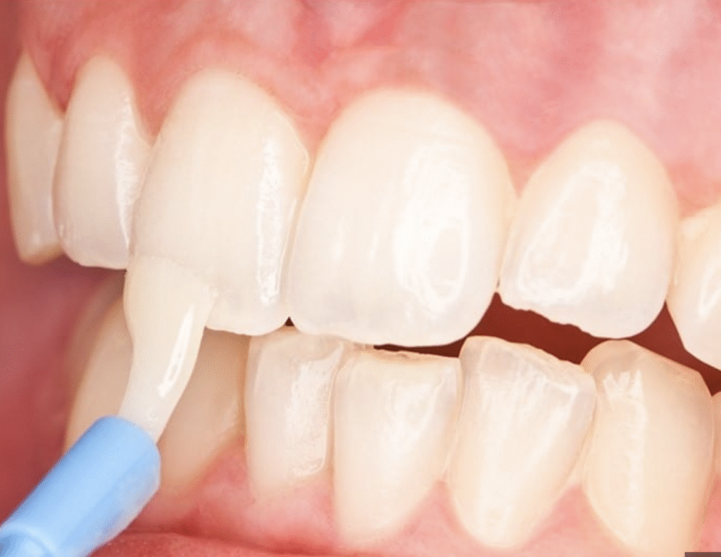 Fluoride treatment applied to patient’s teeth in Grayson